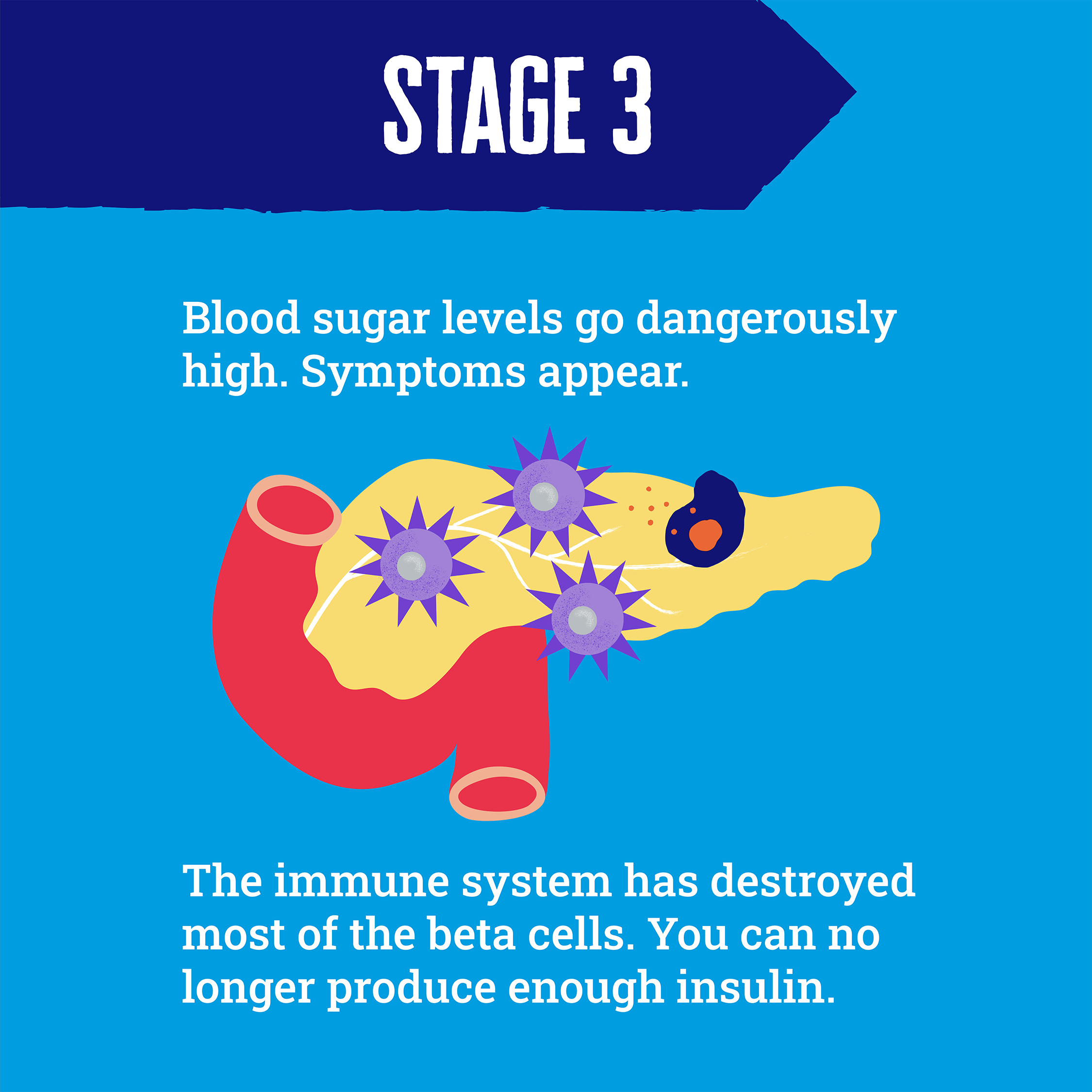 Illustration showing beta cells in decline in a pancreas, with lots of attacking immune cells